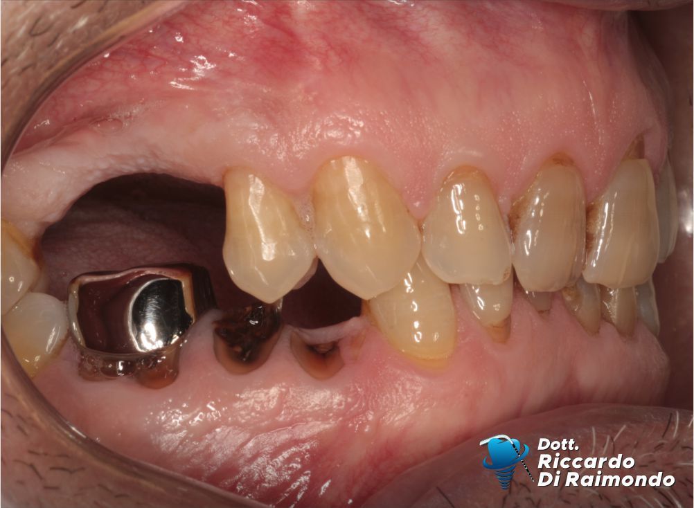 Prima del trattamento di Parodontologia