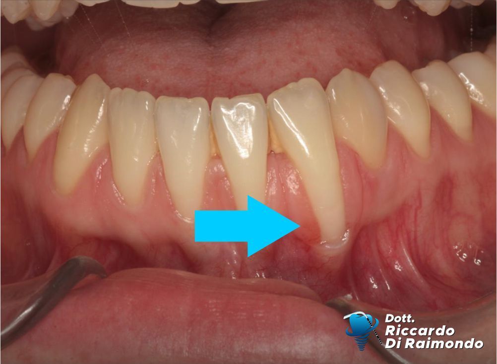 Prima del trattamento di Parodontologia