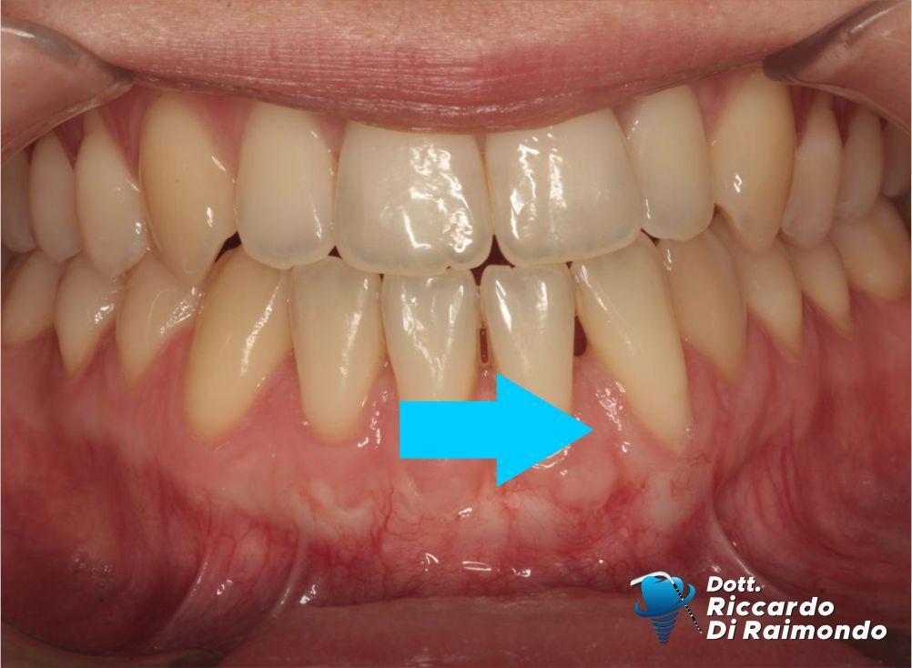 Prima del trattamento di Parodontologia