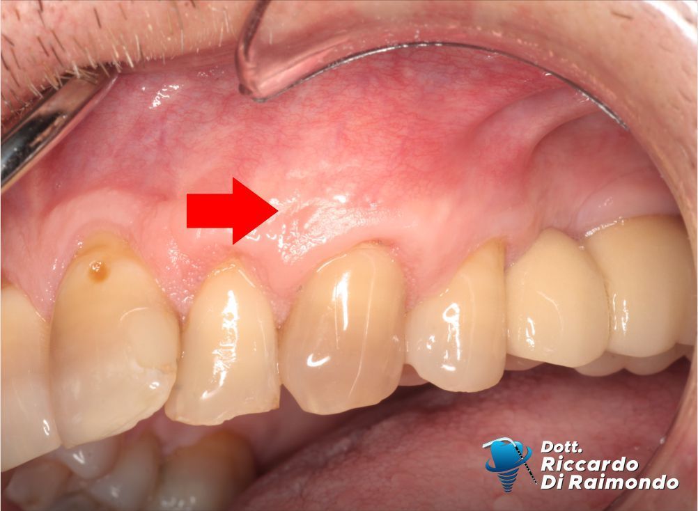 Prima del trattamento di Parodontologia