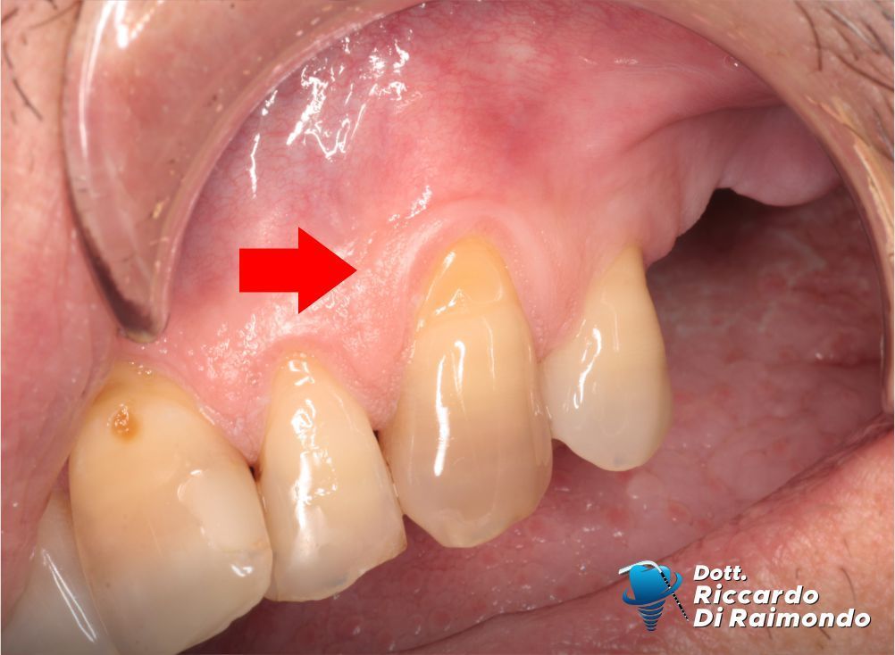 Prima del trattamento di Parodontologia