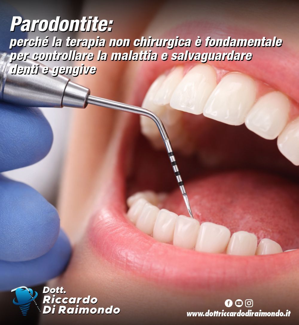 Parodontite: perché la terapia non chirurgica è fondamentale per controllare la malattia e salvaguardare denti e gengive