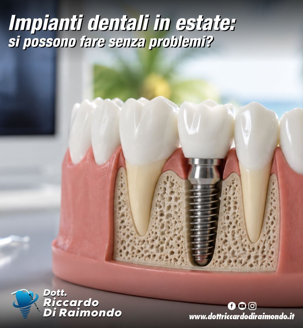 Impianti dentali in estate: si possono fare senza problemi?