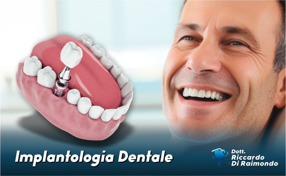 Implantologia dentale