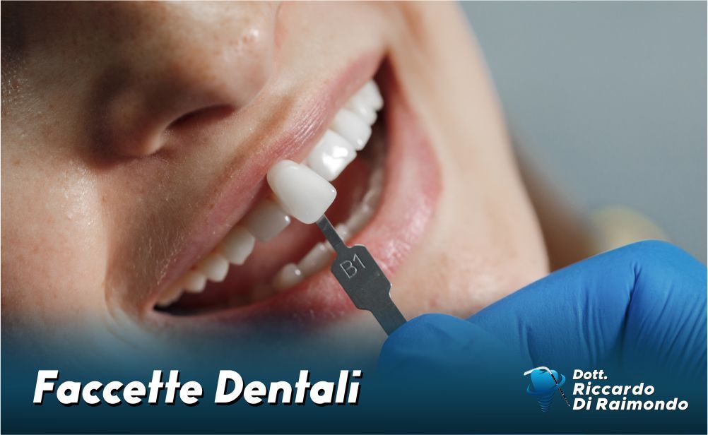 Faccette Dentali