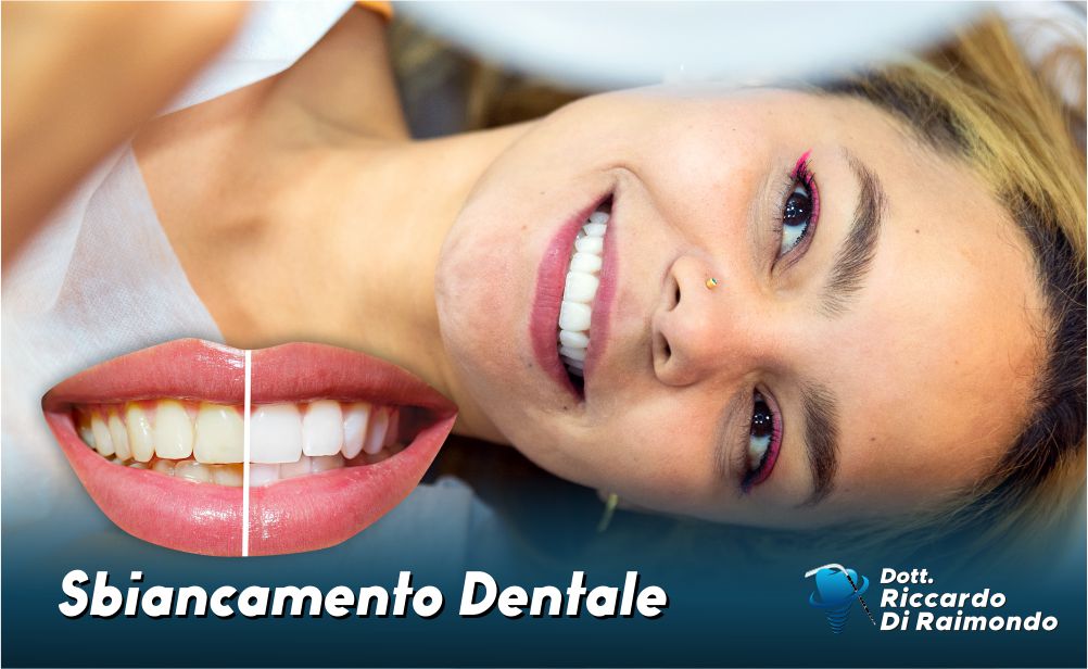 Sbiancamento Denti