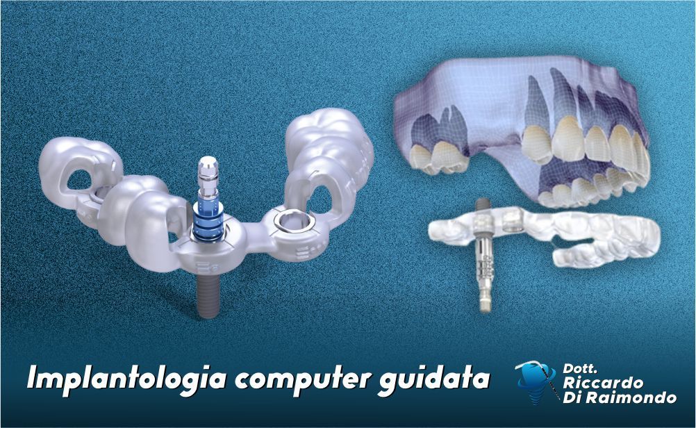 Implantologia computer guidata