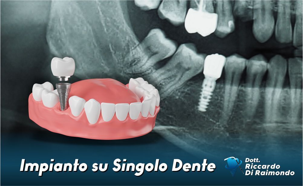 Impianto su singolo dente