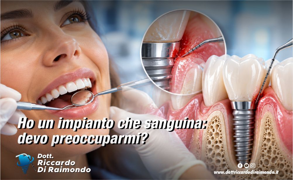 Articolo Blog Dott. Riccardo Di Raimondo - Dentista specializzato in implantologia e parodontologia a Palermo.