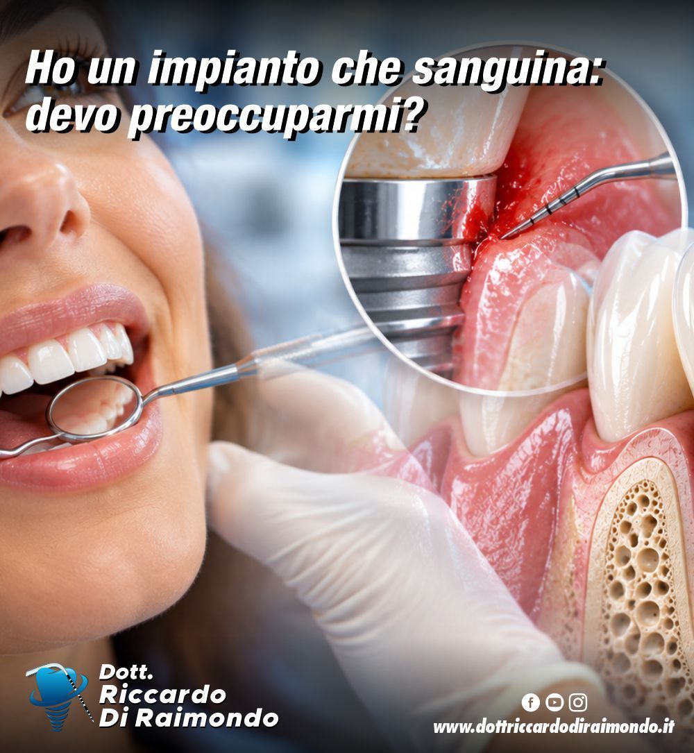 Ho un impianto che sanguina: devo preoccuparmi? I segnali da non sottovalutare intorno agli impianti dentali